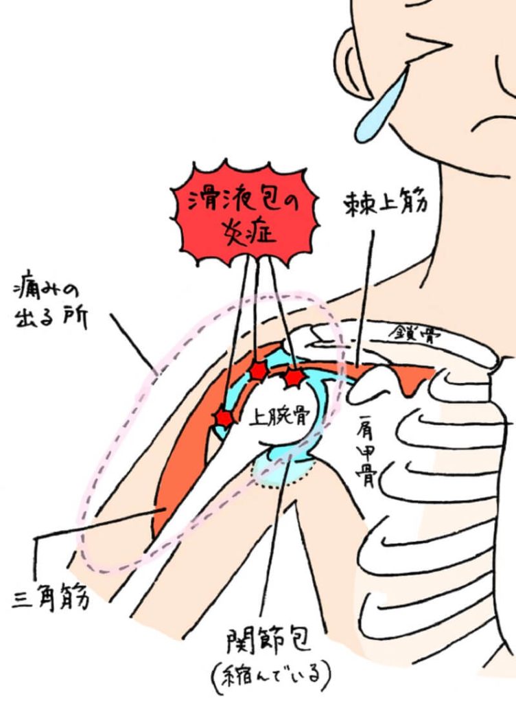 関節包・滑液包の炎症の図